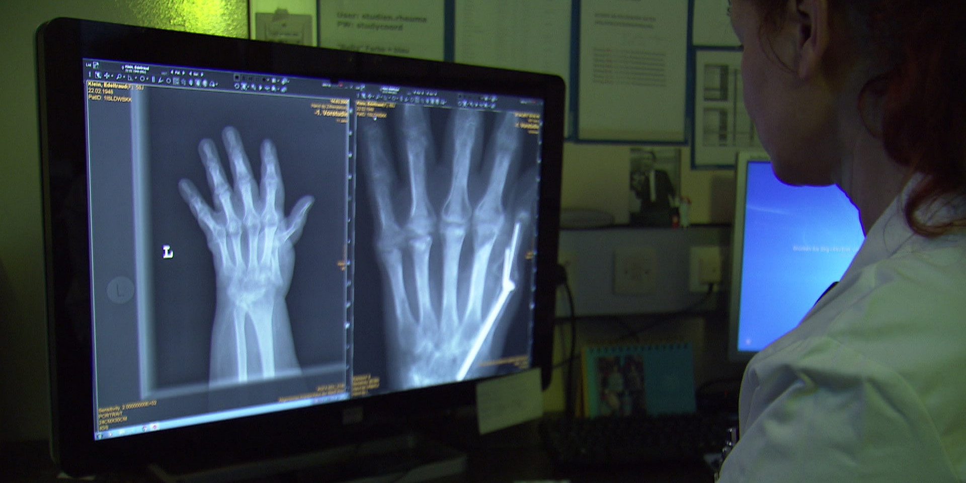 © ORF bewusst gesund am 3.3.2018: Rheumatoide Arthritis – Vom Aderlass zur Gentechnik