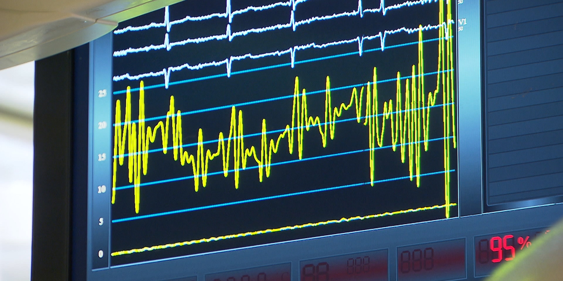 © ORF "bewusst gesund" am 8.2.2020: Überlauf - Entlastung bei Herzschwäche