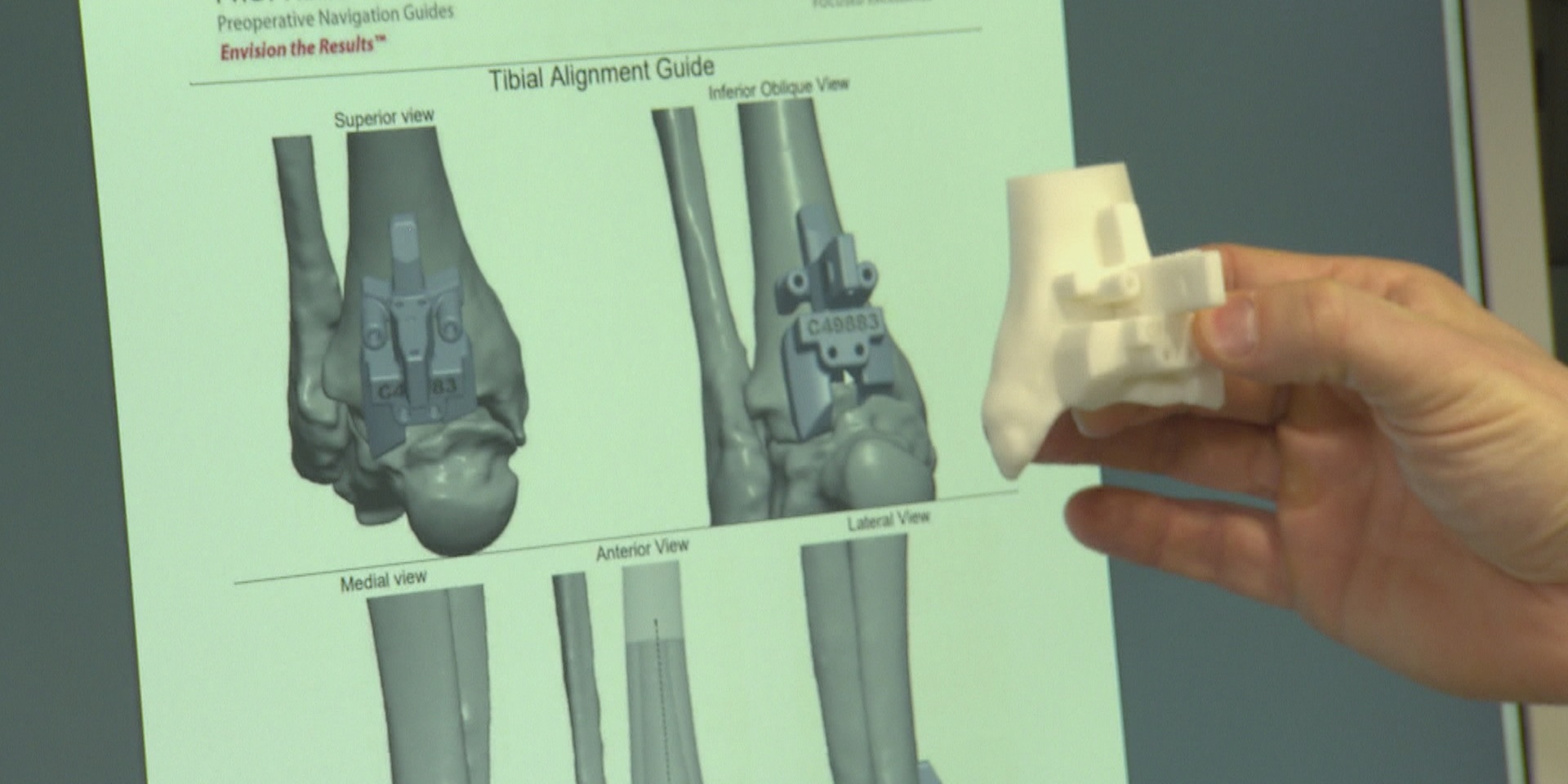 © ORF "bewusst gesund" am 13. Februar: Maßarbeit – Gelenksersatz aus dem 3D-Drucker