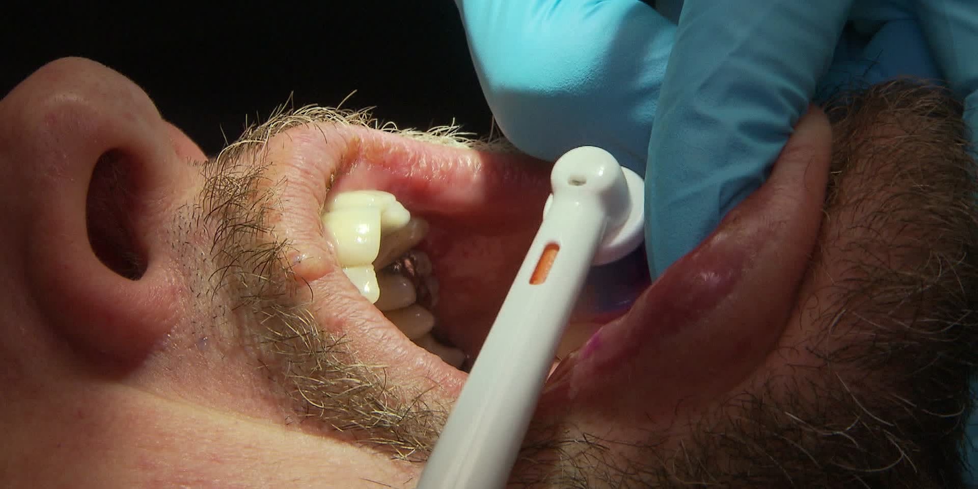 "bewusst gesund" am 7.1.2023: Parodontitis - Zahnausfall lässt sich verhindern